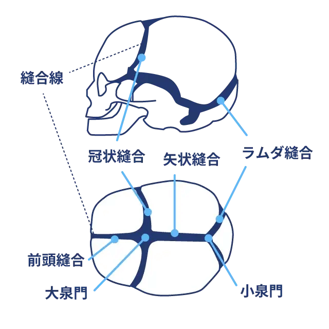 病的な頭蓋変形症（頭蓋骨縫合早期癒合症）