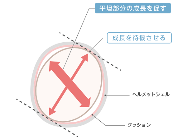 ヘルメット治療の原理