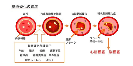 動脈硬化の進展